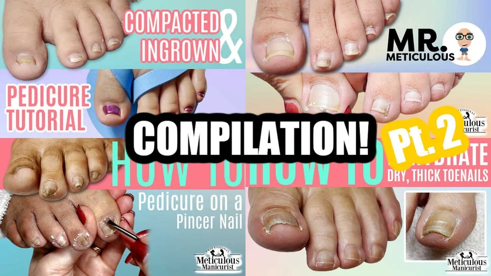 Pedicure Compilation on Impacted, Ingrown, and Pincer Toenails (Part 2
