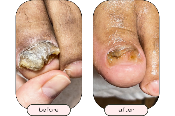 Close up picture of a thick toenail before restorative care