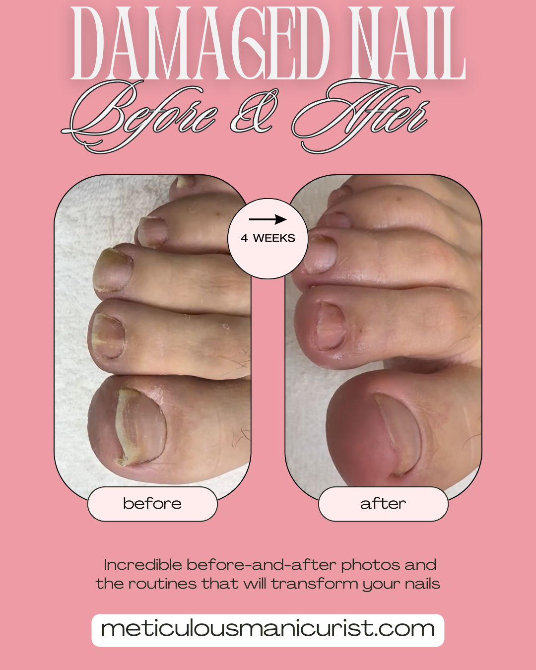 damaged toenail problem fix.png