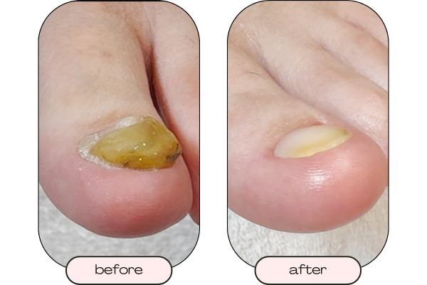 Side view of a thick toenail showing increased nail thickness