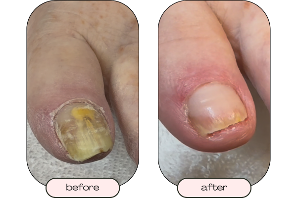 Yellow thick toenail before cosmetic restorative care