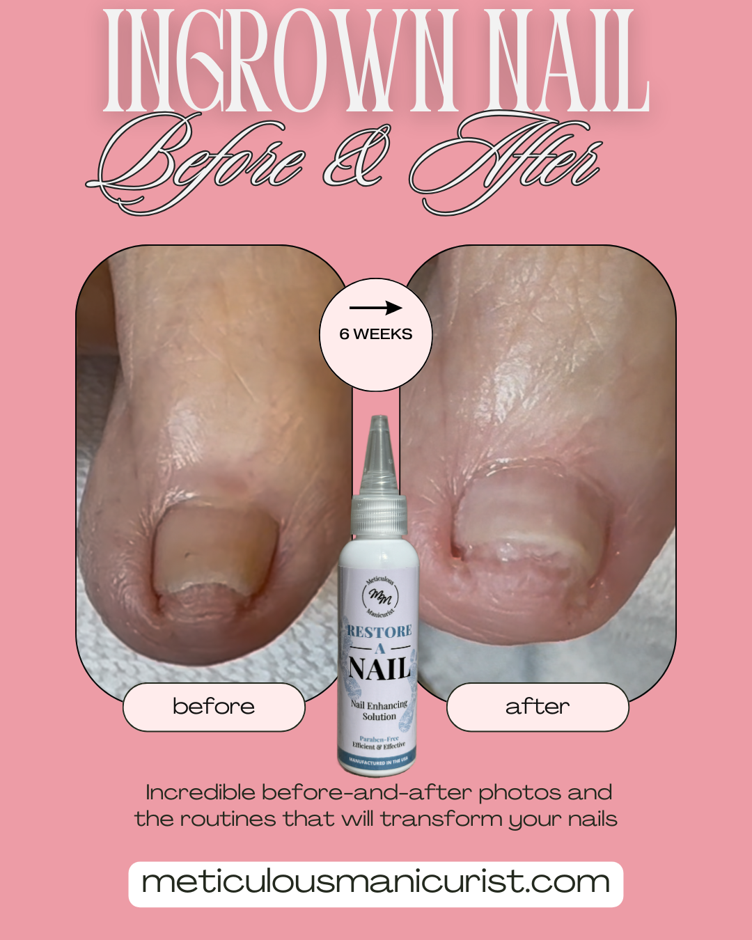 ingrown toenail relief.png