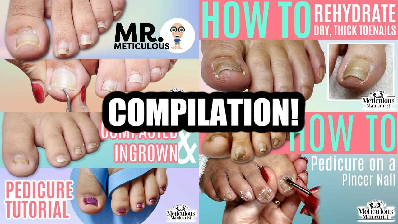 Pedicure Compilation on Impacted, Ingrown, and Pincer Toenails (Part 1