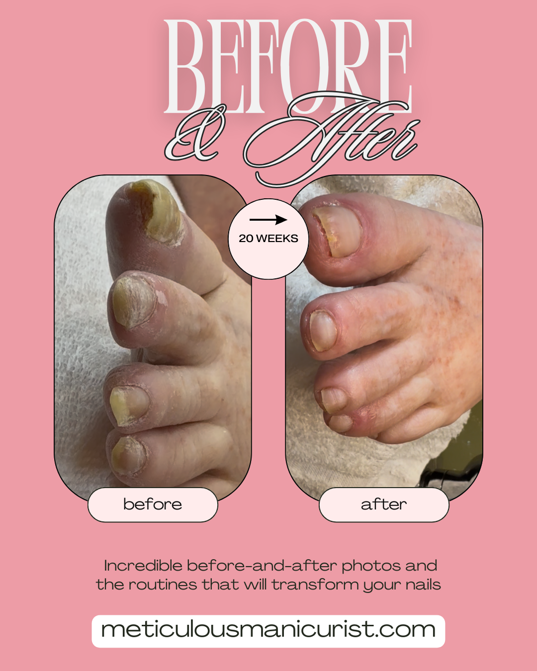 painful toenail fix at home.png