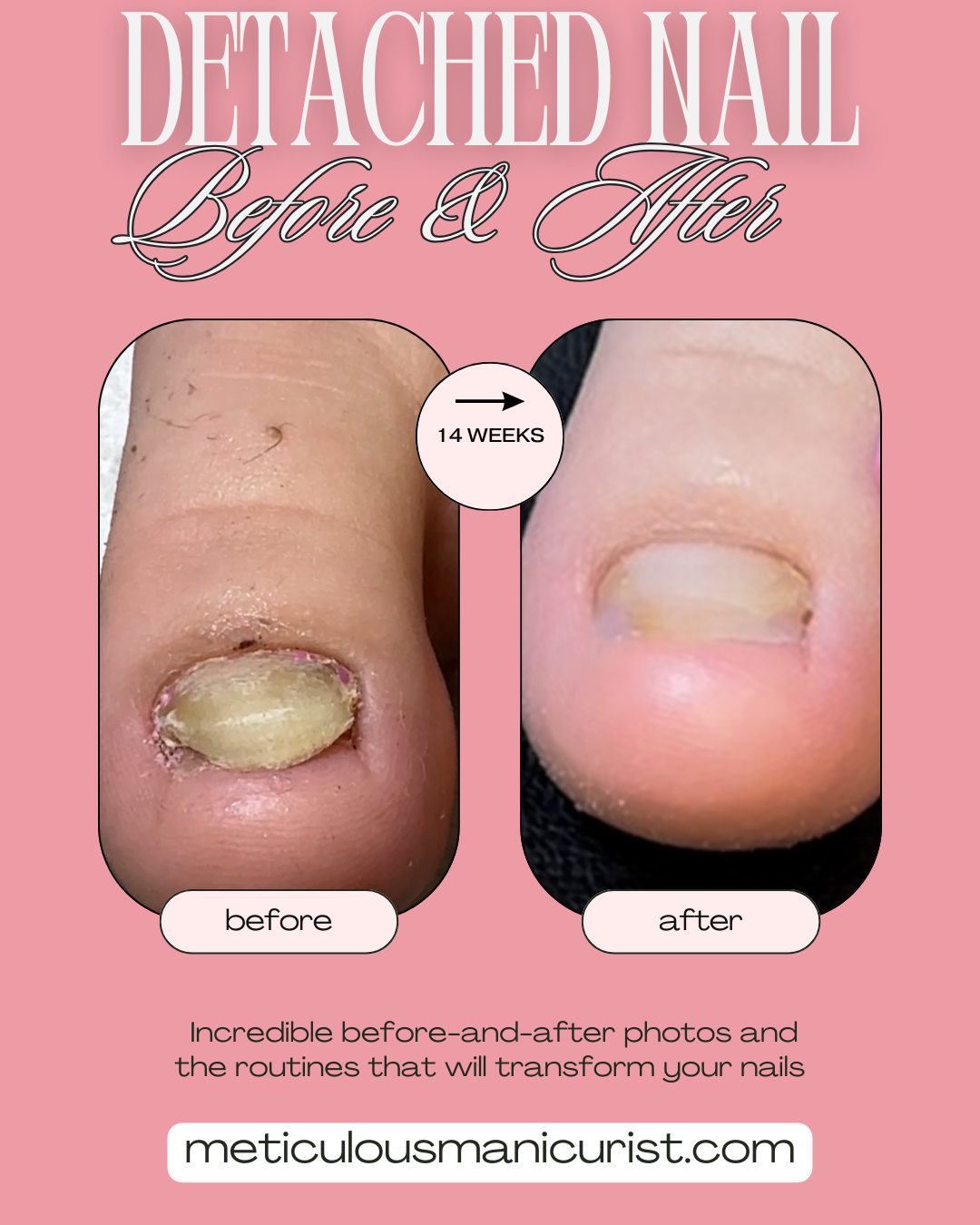 fix lifted detached toenail at home.png