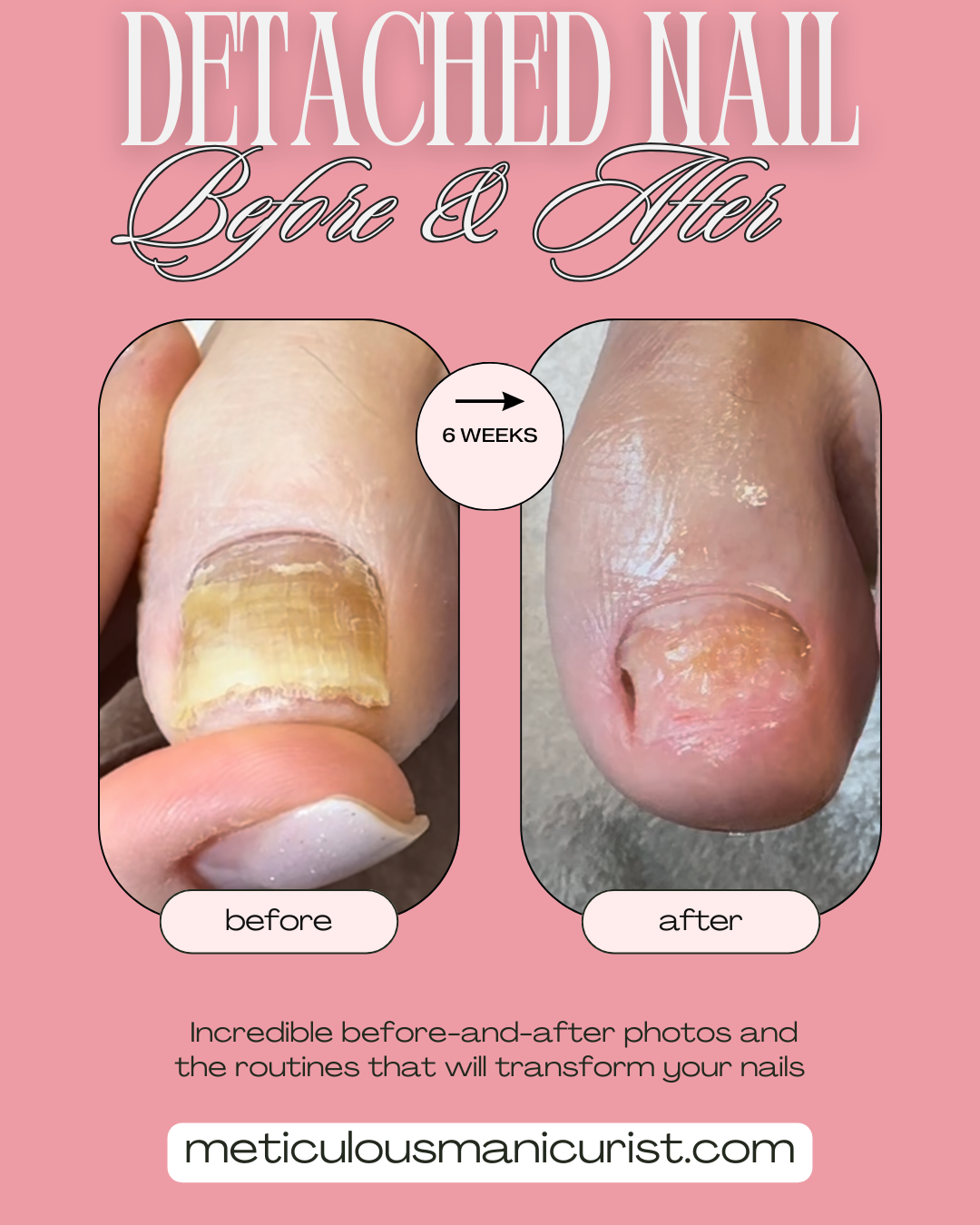 detached yellow toenail fix.png
