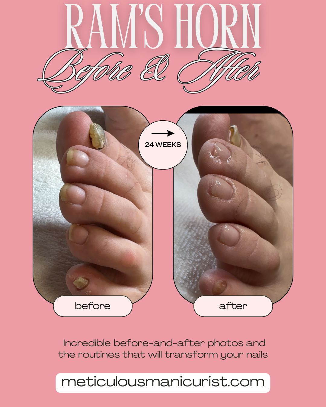 fix rams horn toenail.png