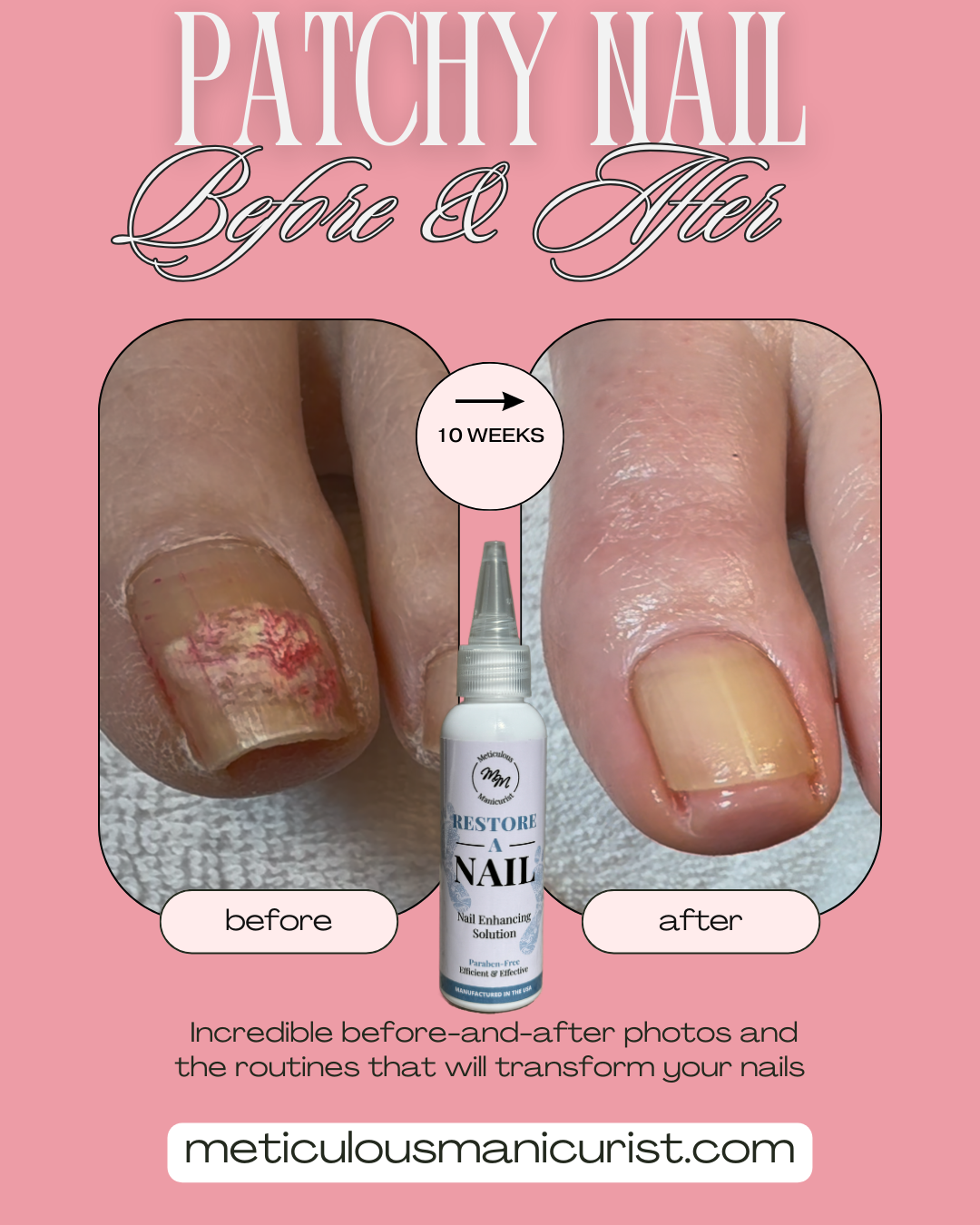 dry patchy toenail fix.png