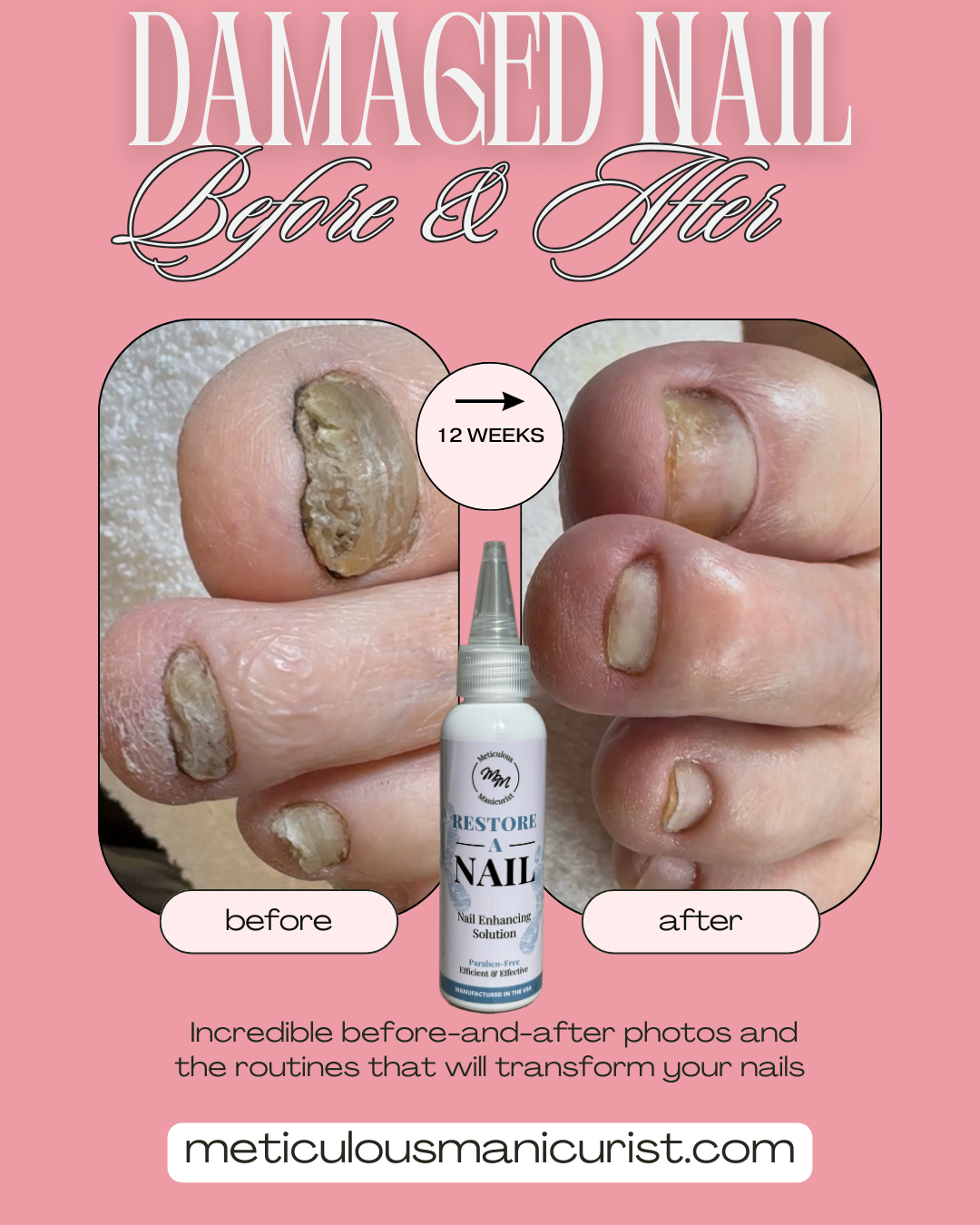 damaged toenail fix.png
