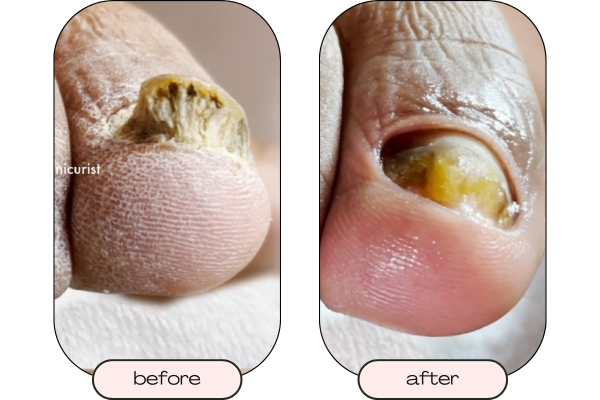 Close up picture of a thick toenail before restorative care