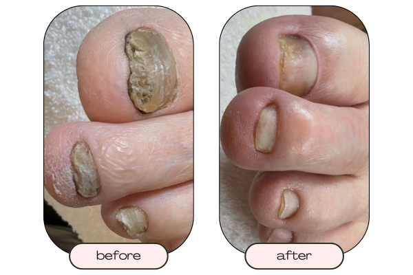 Close up of thick toenail before restorative care