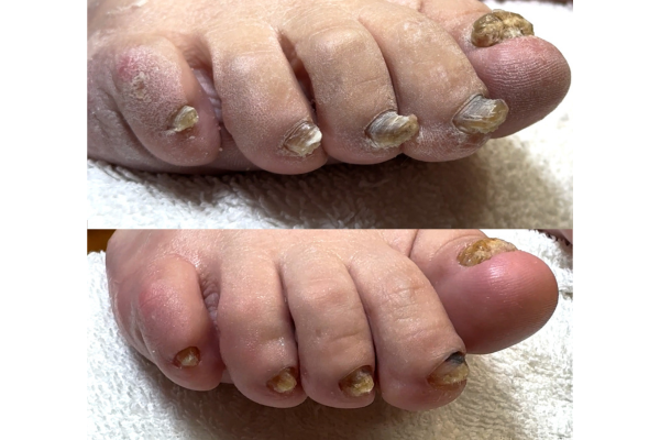 Before and after thick toenail pressure relief