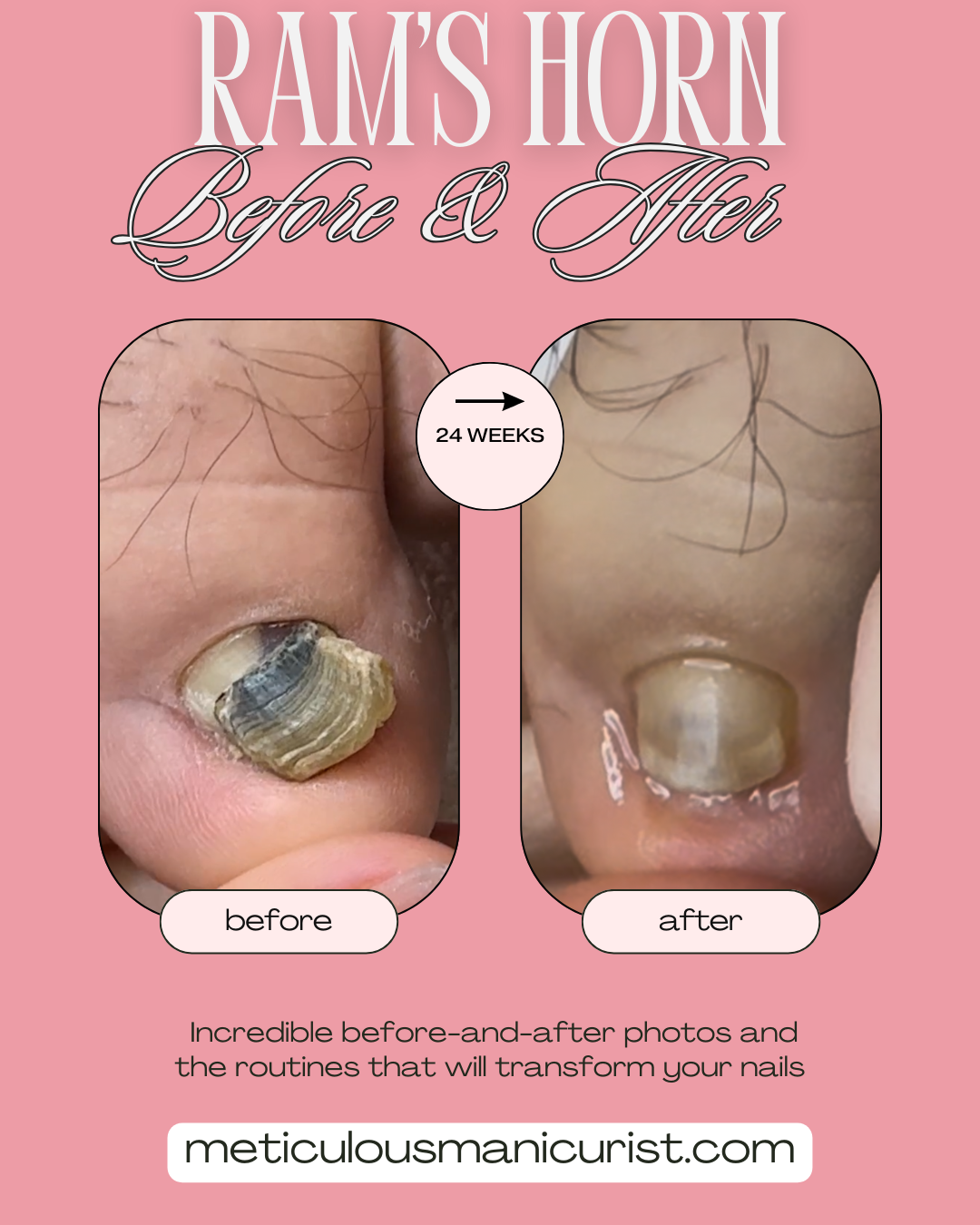 fix rams horn toenail at home.png