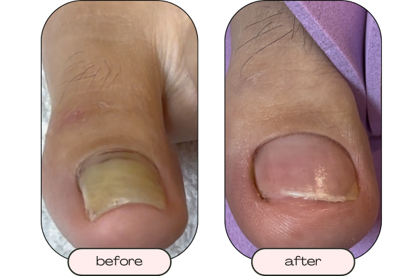 Thick toenail caused by pressure trauma or nail buildup