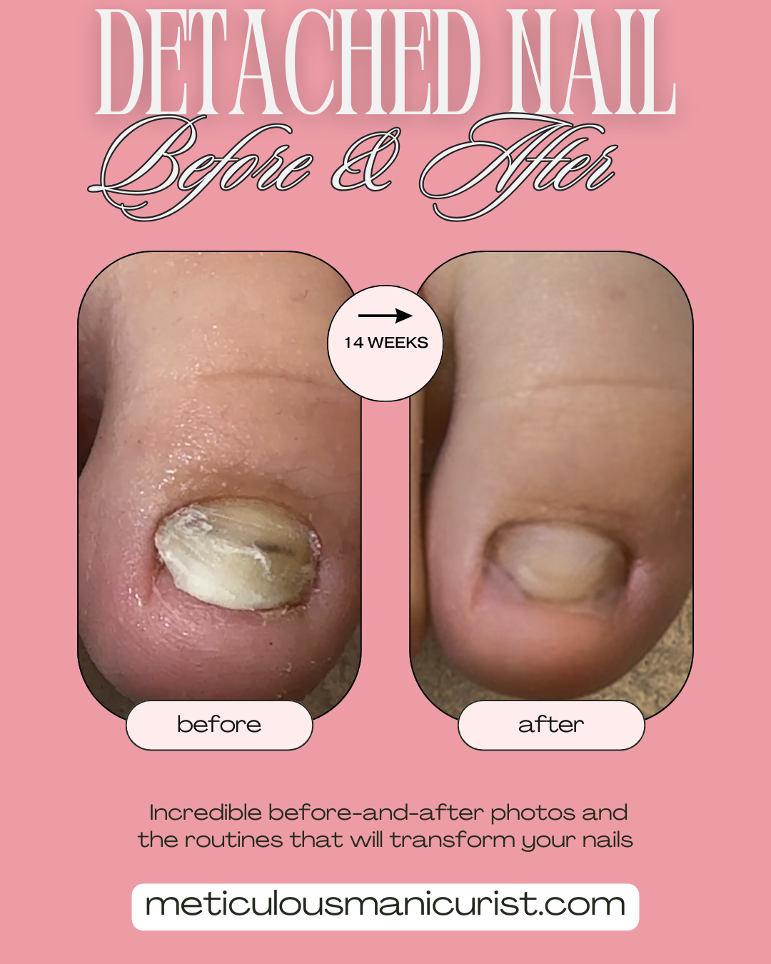fix detached lifted toenail problem at home.png