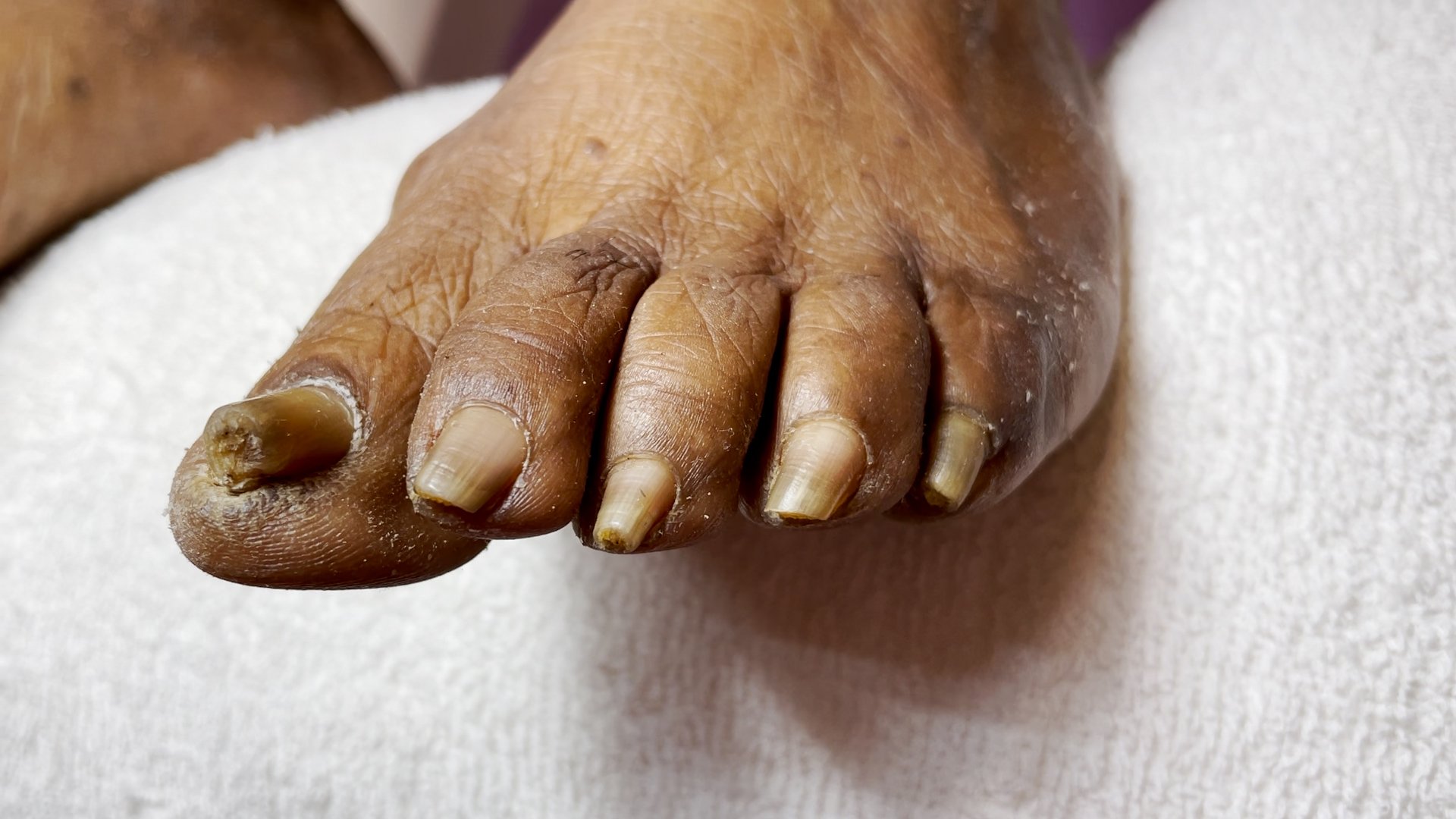 How To Fix Pincer Toenails [What You Need To Know]