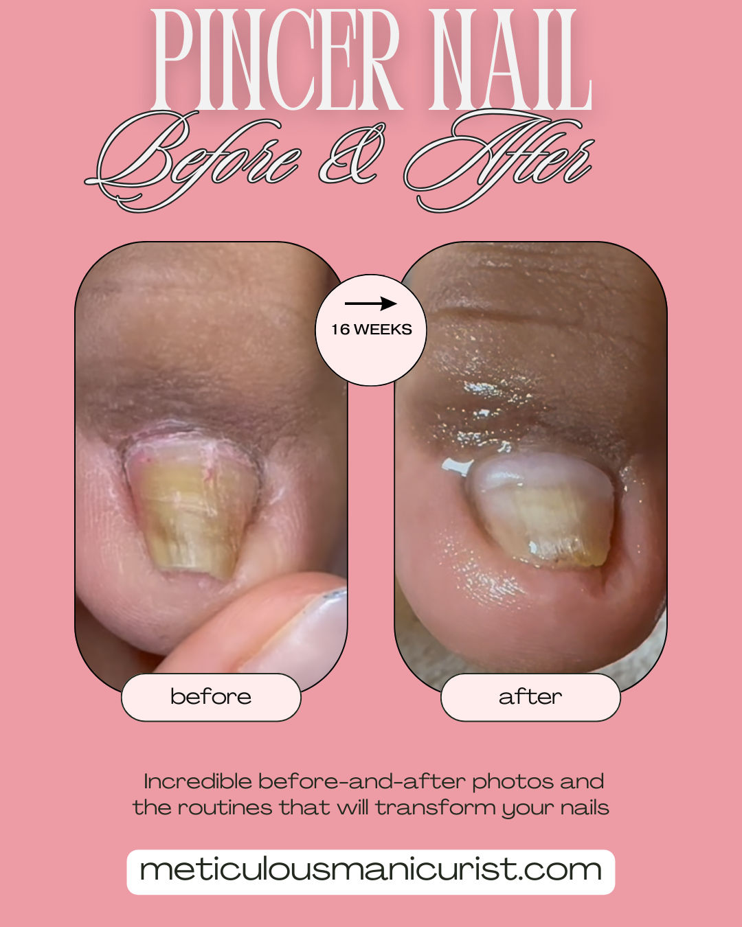 pincer ingrown squeezing toenail fix.png
