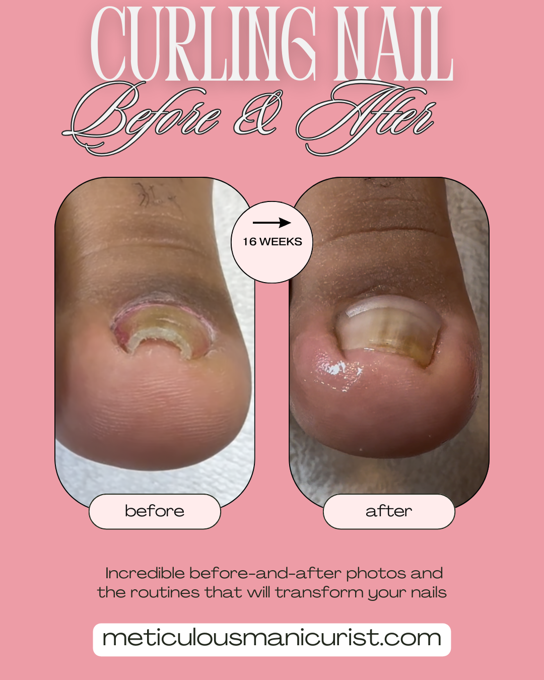 curling ingrown pincer toenail fix.png