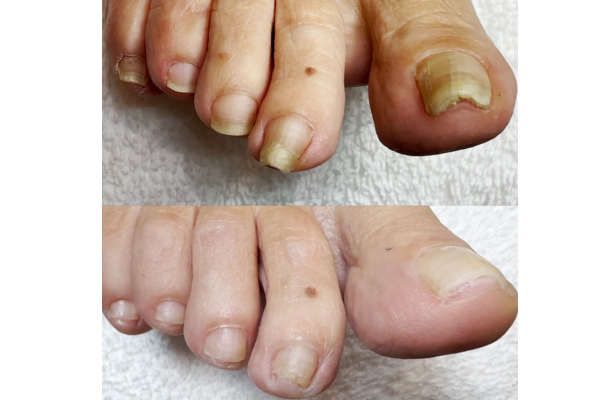 Side view of thick toenail showing nail pressure and thickness