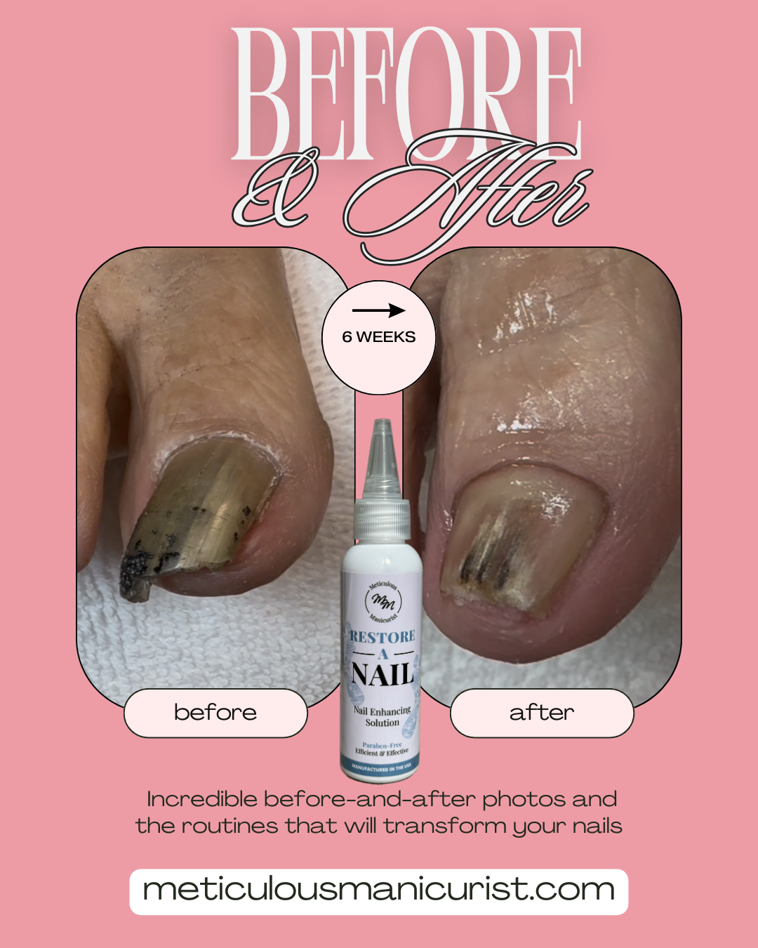 thick discolored toenail fix.png
