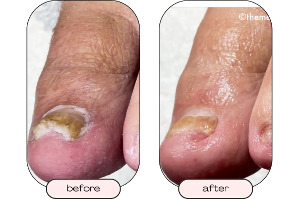 Close up picture of a thick toenail before restorative care