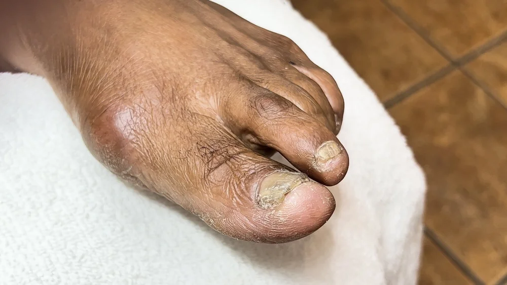 Toenail Fungus Reverse Toenail Changes — Meticulous Manicurist