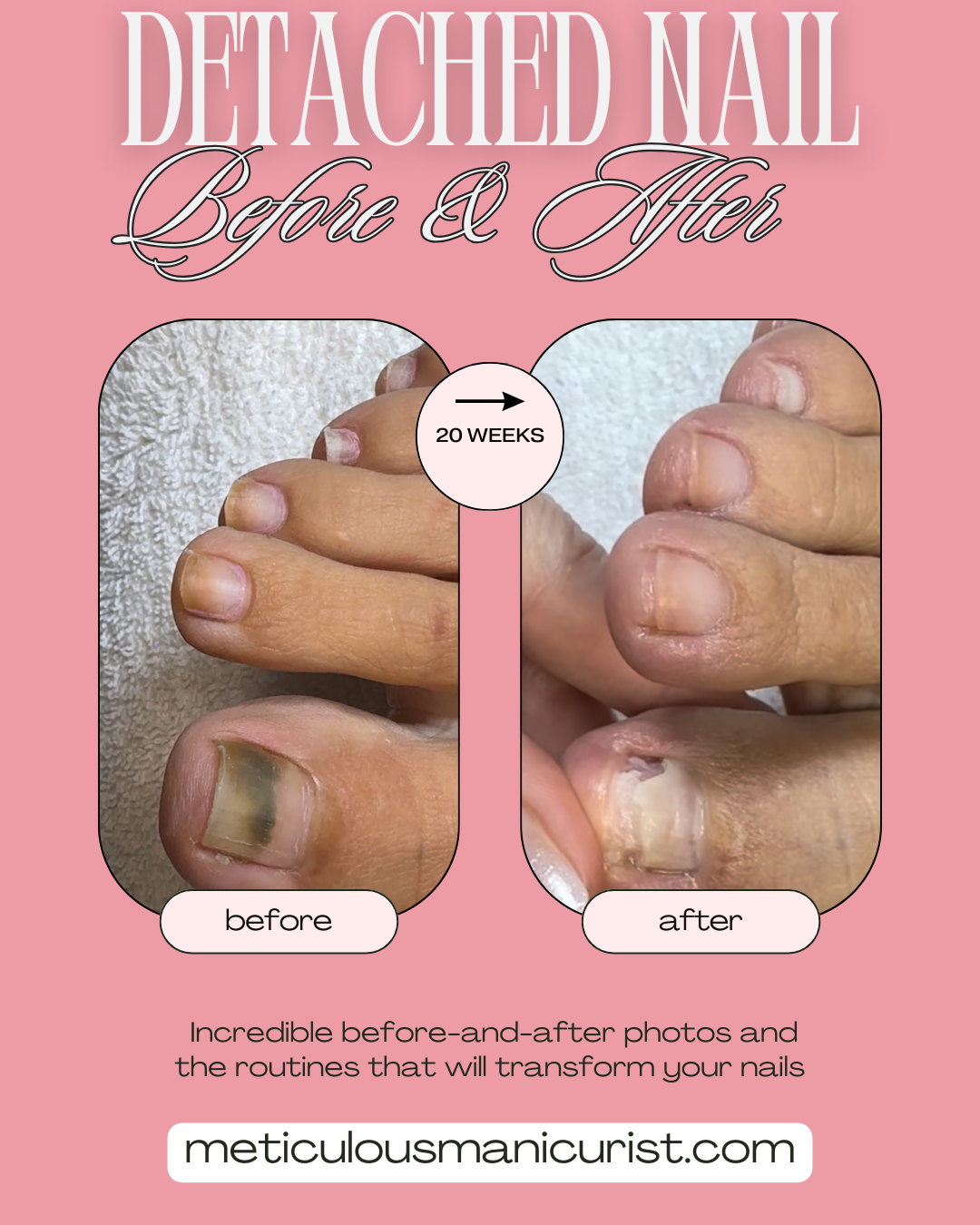 detached lifted toenail fix.png