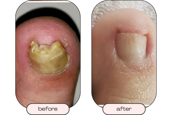 Close up picture of a thick toenail before restorative care