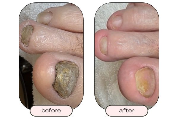 Toenail with yellow discoloration and suspected nail fungus