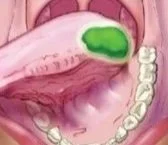 Detecting cancer with PARPi inhibitors