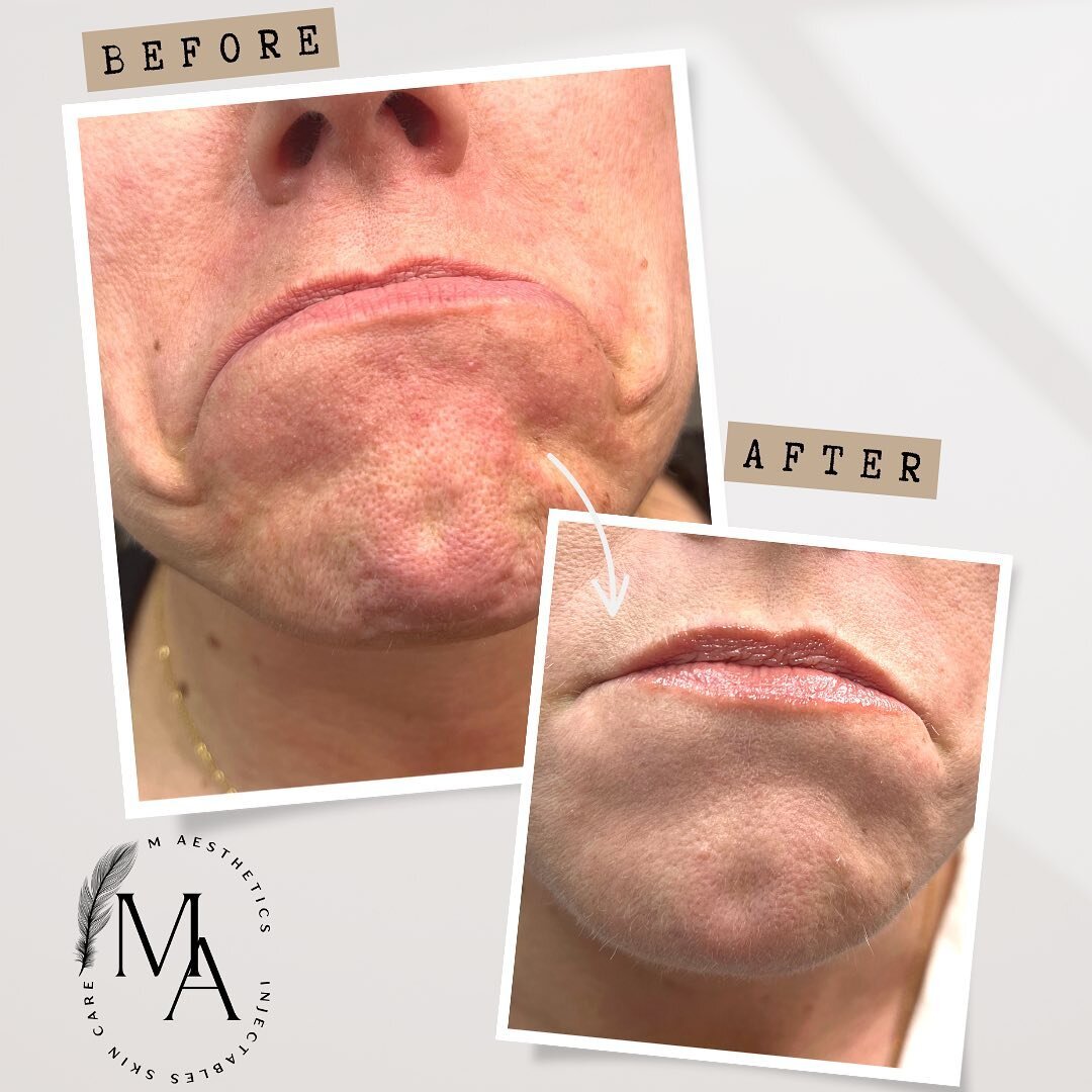 𝗫𝗲𝗼𝗺𝗶𝗻 𝘄𝗶𝗻𝘀 𝗮𝗴𝗮𝗶𝗻!

Yes we all love wrinkle free foreheads and frowns but slowly my favorite neurotoxin use is lower face! Can you see the difference?! Crows feet are also a wonderful place to erase wrinkles. 

Remember neurotoxin take