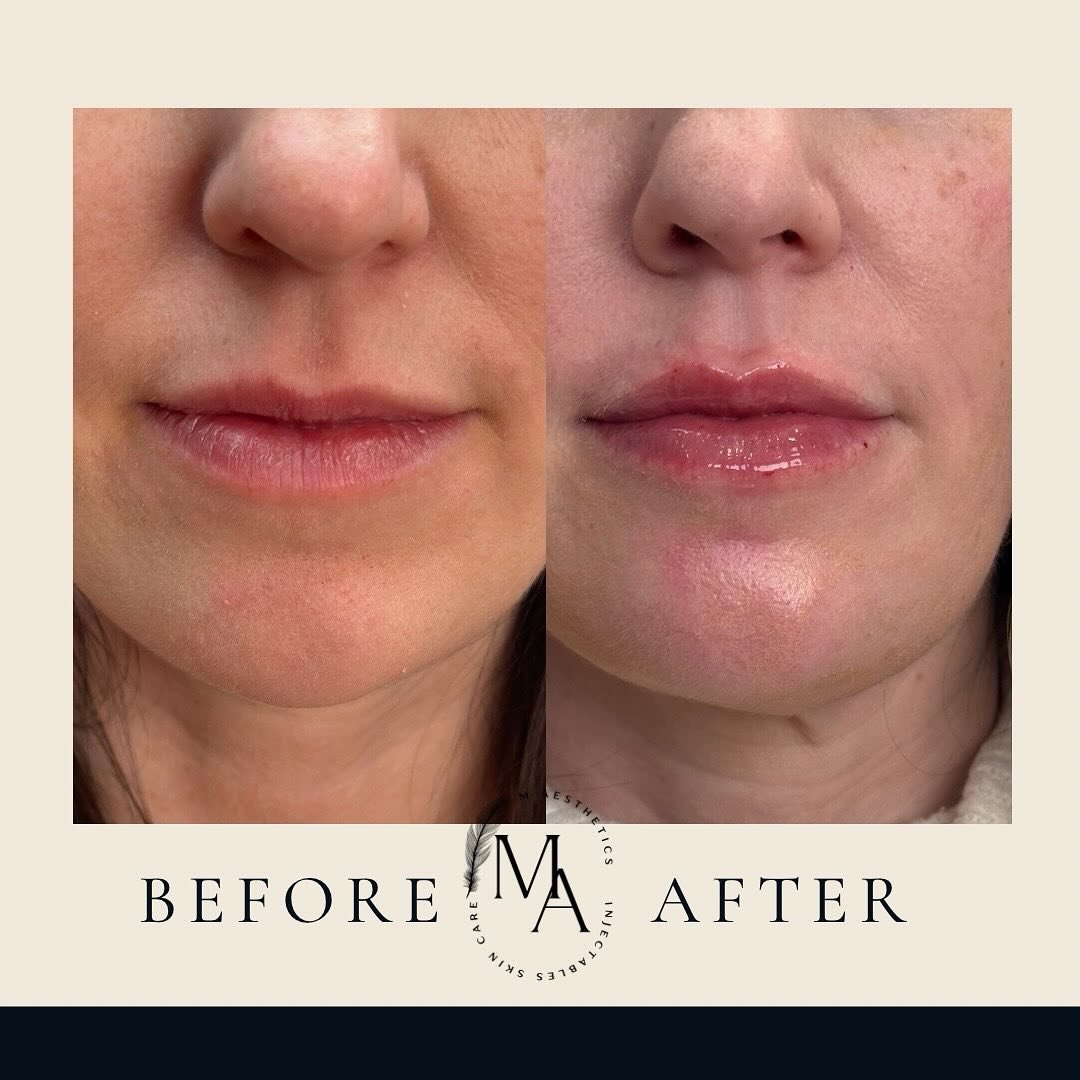 ✨ Signature Sculptra Glow-Up! ✨

Look at this beauty&rsquo;s transformation! 🌟
After her full Sculptra treatment last year, all she needed was one maintenance vial to keep that gorgeous, youthful glow. To enhance the results, we added one syringe of