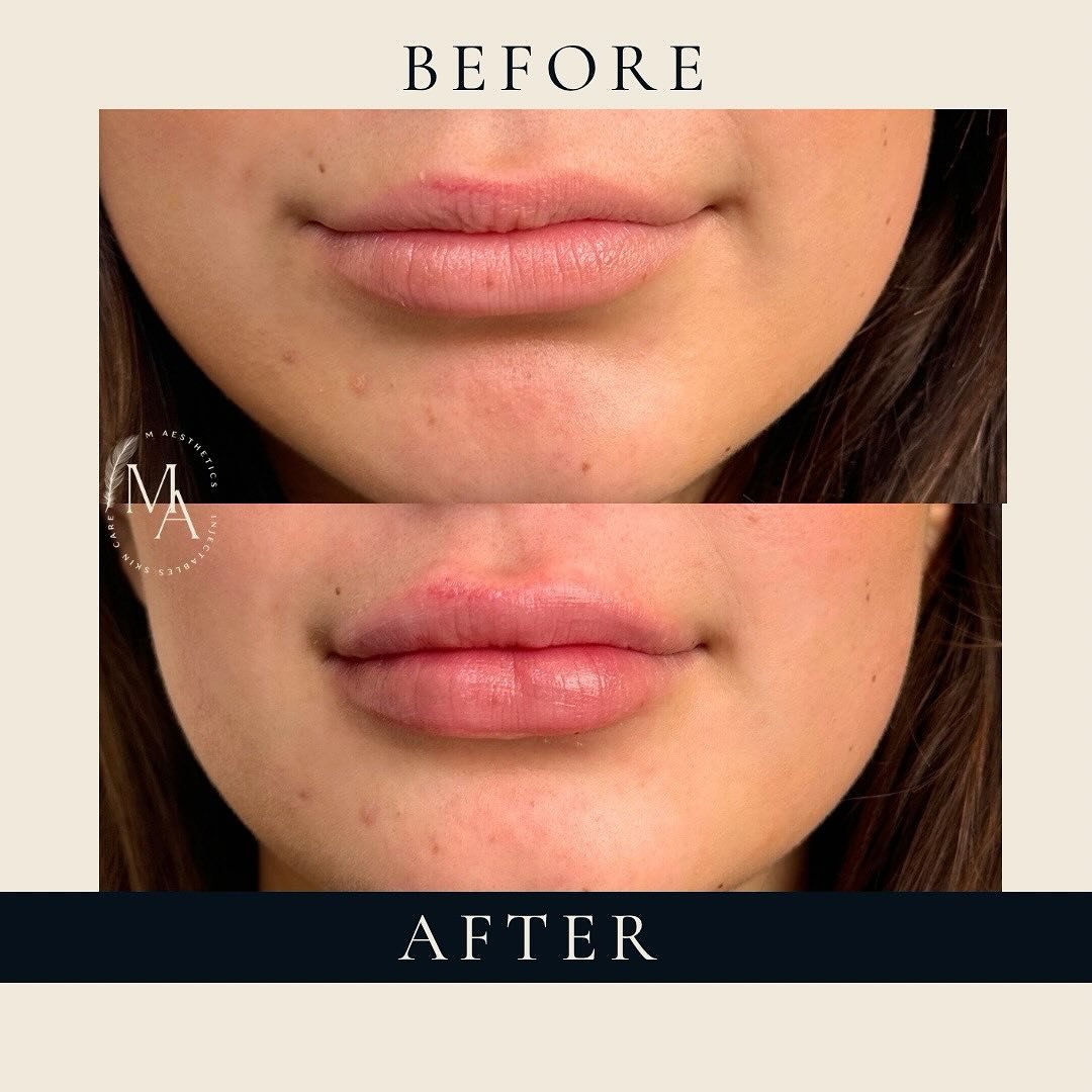 ✨ First Time Lips ✨

It&rsquo;s amazing how just a little can make such a difference! This lovely client came in wanting a subtle, natural enhancement &ndash; her goal was simply to add a touch of symmetry and a little plump. Using a small amount of 