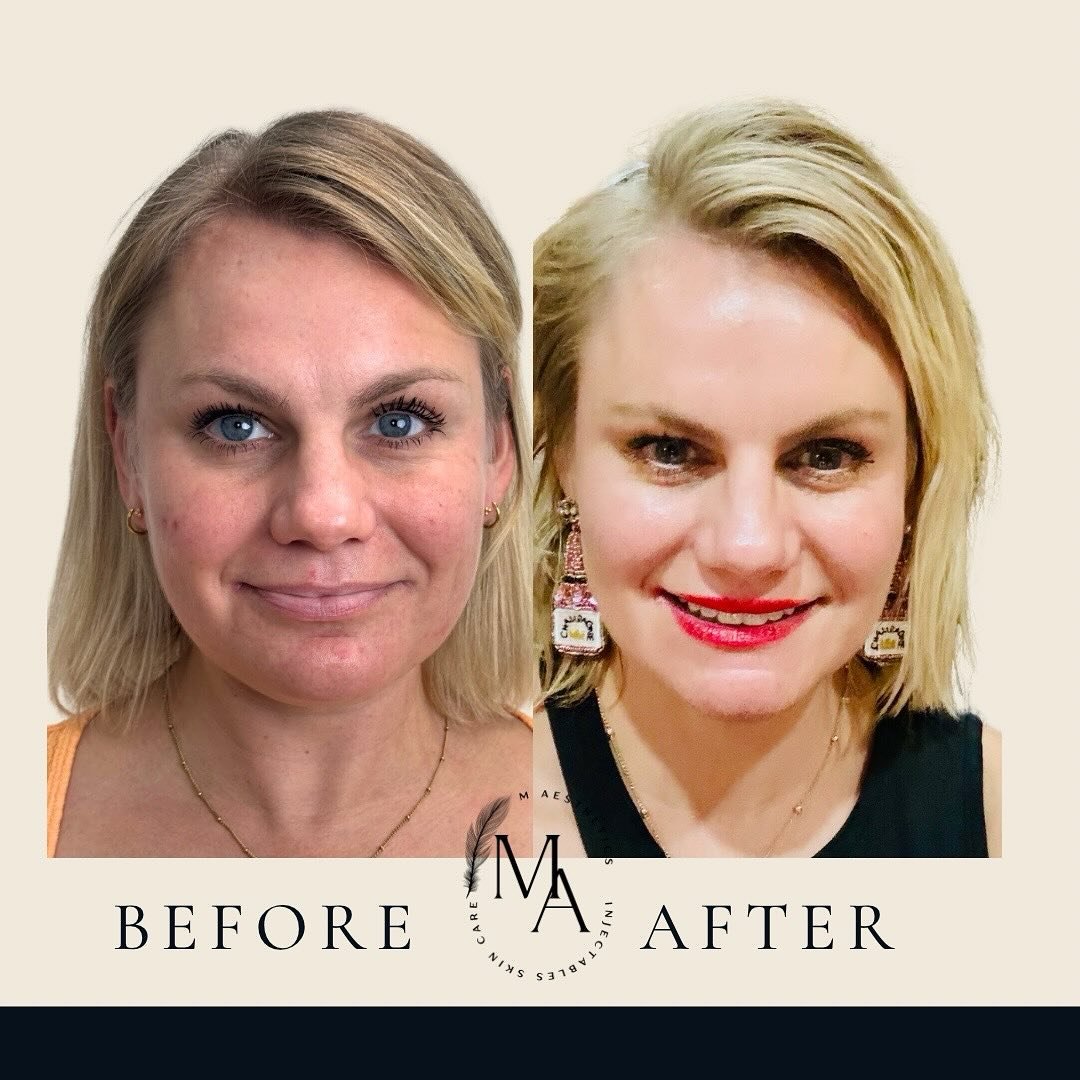 ✨ Incredible VI Peel Results in Just 7 Days! ✨

Swipe to see the glow-up ➡️
Whether you experiencing mild peeling or full sheets of skin shedding, one thing is guaranteed&mdash;radiant, glowing skin in just one week!

The VI Peel is perfect for anyon