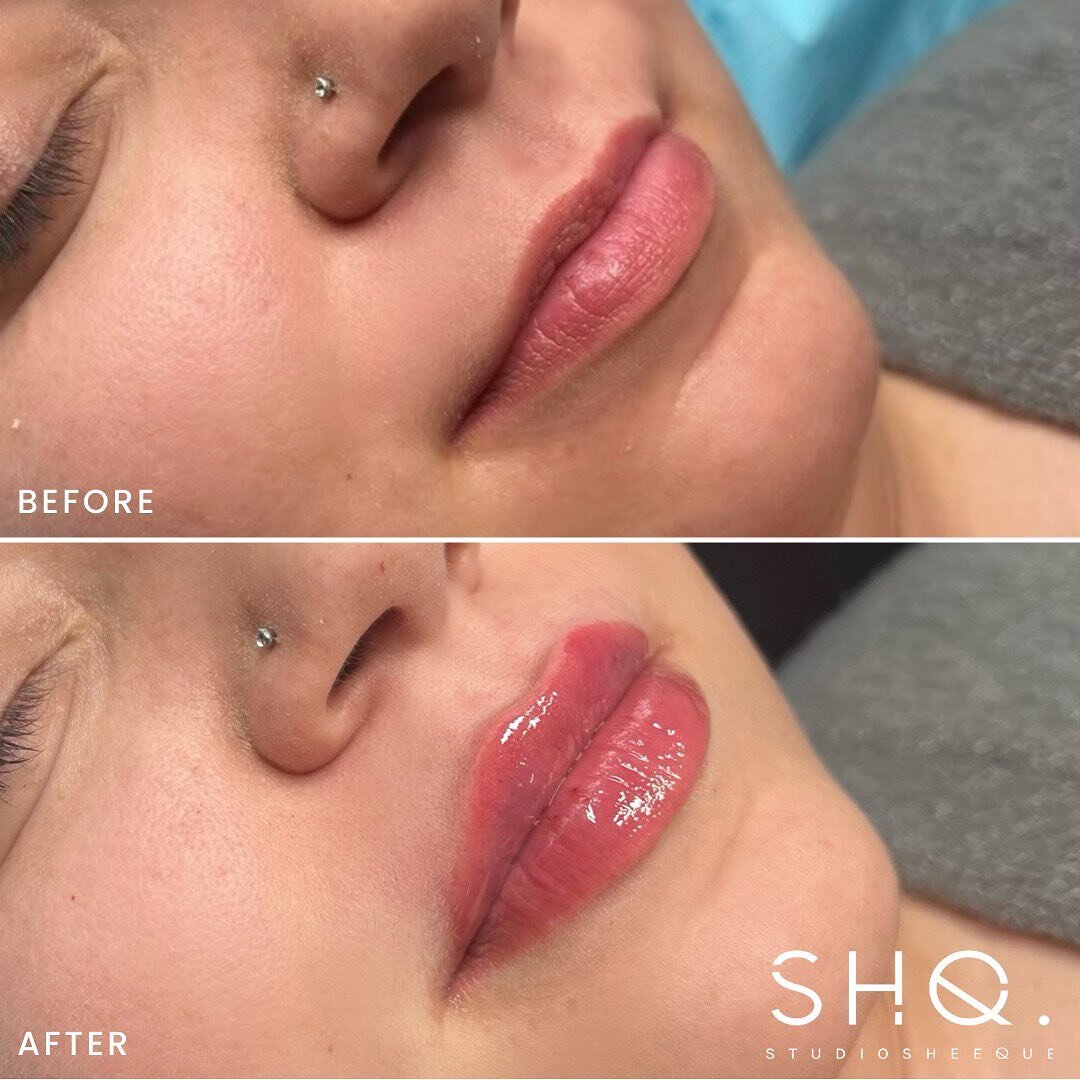 Lips by SHQ 👄 

Message us for any booking inquiries✨

#toronto #yyz #gta #torontobotox #torontofillers #botox #fillers #cosmeticinjectables #torontolips #torontonurseinjector #lipfillers #beauty #torontobeauty #stylagecanada #lipinjections