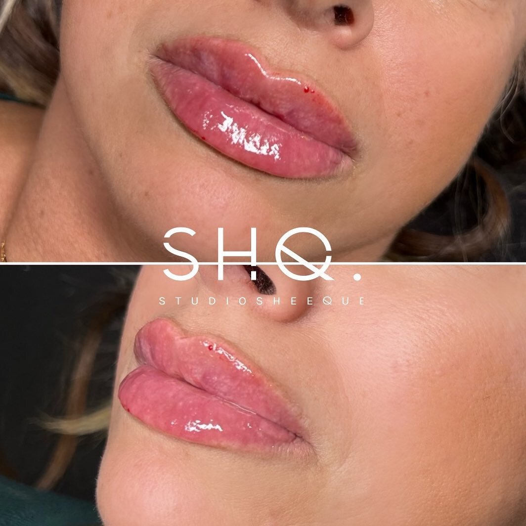 Lips by SHQ 👄 

Message us for any booking inquiries✨

#toronto #yyz #gta #torontobotox #torontofillers #botox #fillers #cosmeticinjectables #torontolips #torontonurseinjector #lipfillers #beauty #torontobeauty #stylagecanada #lipinjections