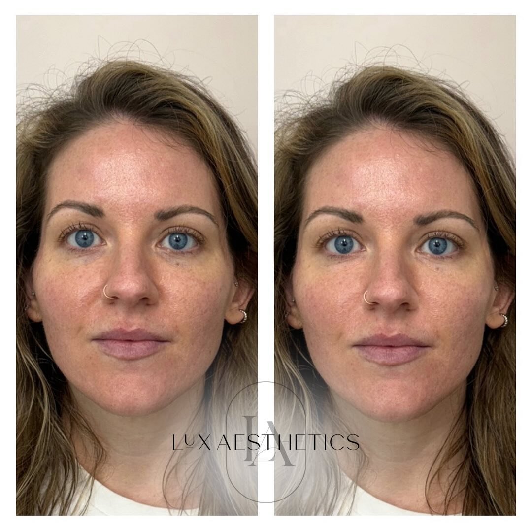 At first glance one might say&hellip; this before and after is exactly the same photo! This is your reminder that dermal fillers should be subtle. Unassuming. And hardly detectable. So what did we do?

She was an excellent tear trough candidate. No b