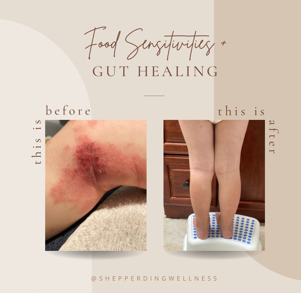 Healing Eczema