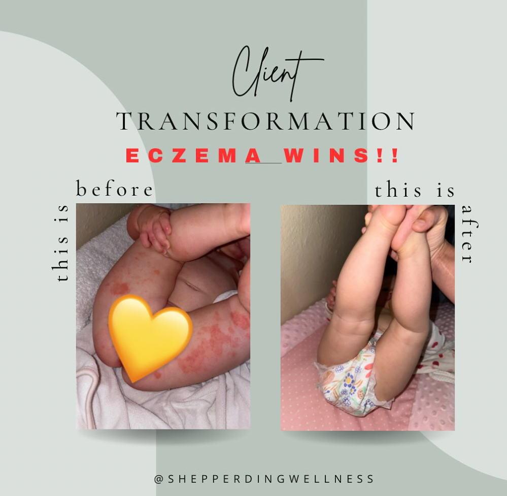 Eczema Healing