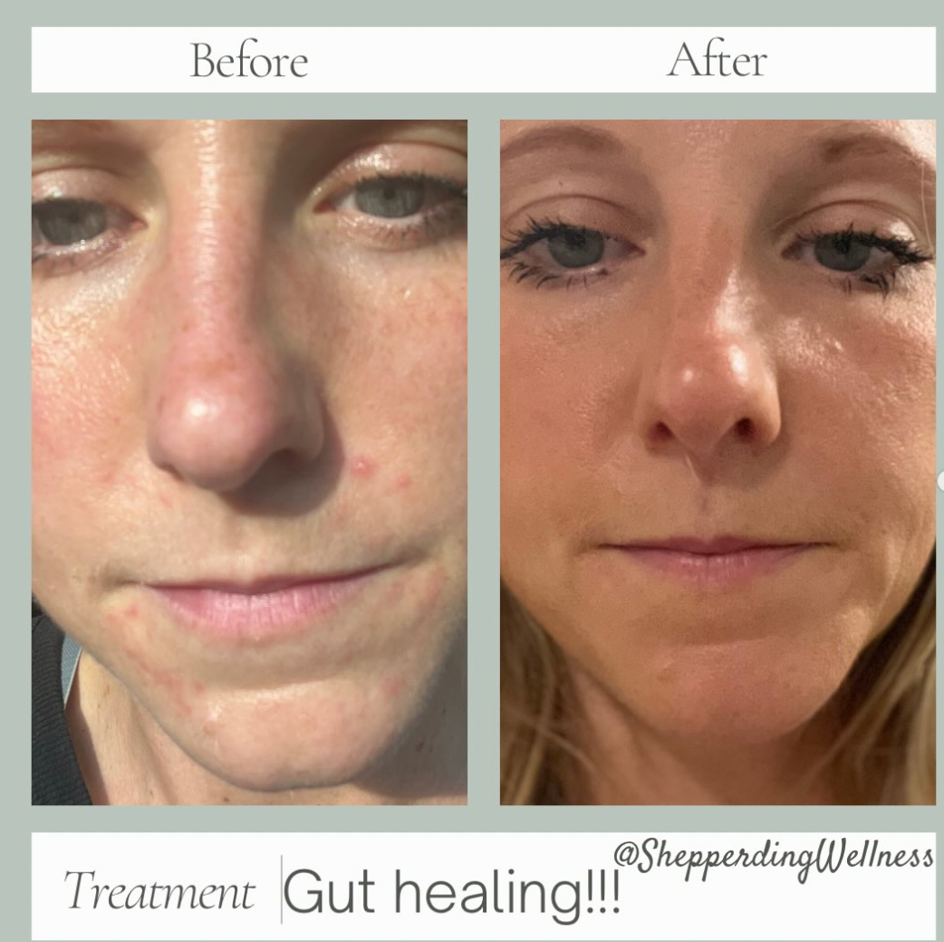 Eczema Healing