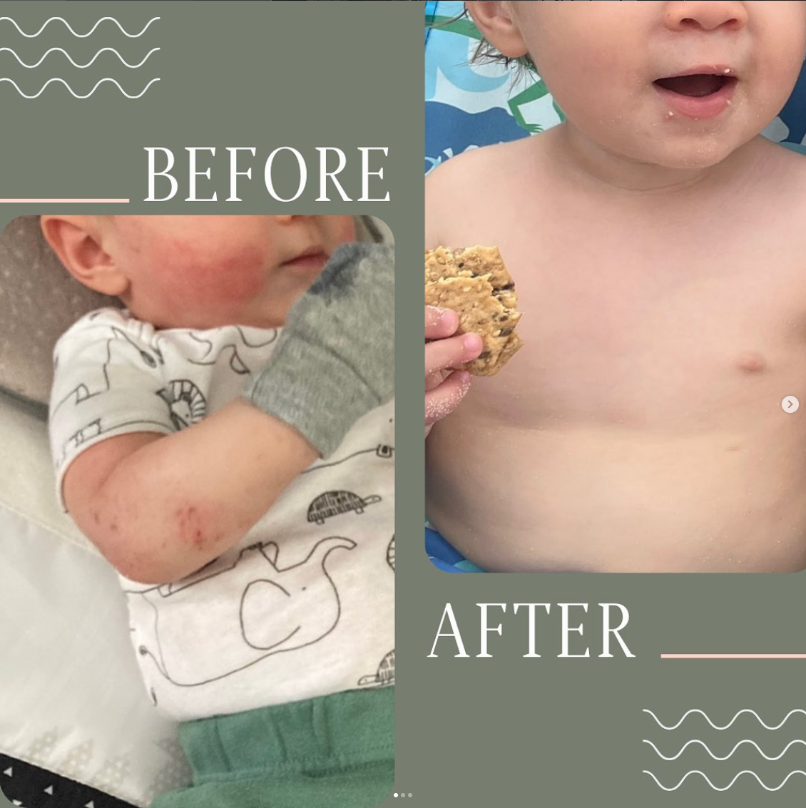 Eczema Healing 