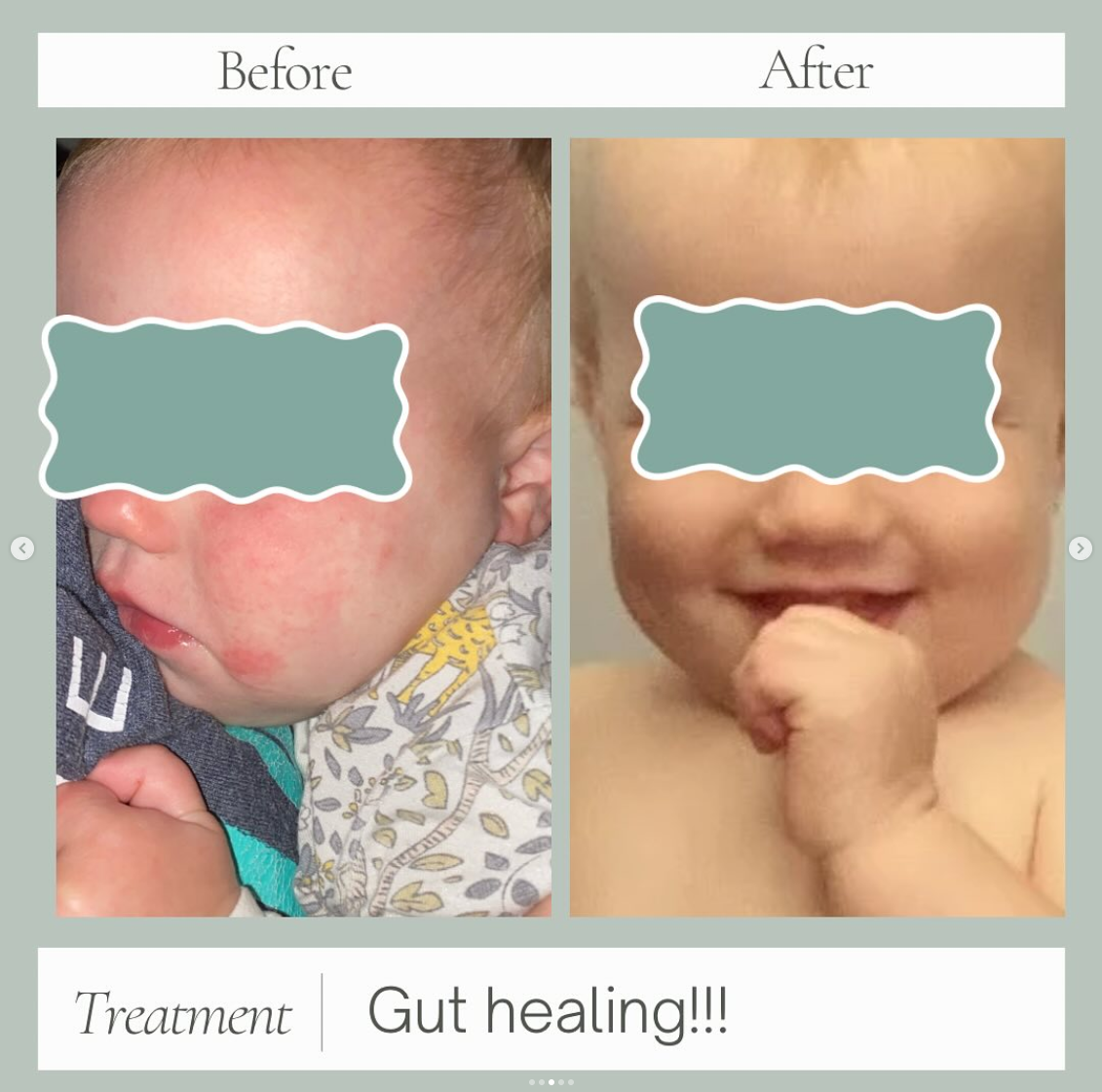 Eczema Healing 