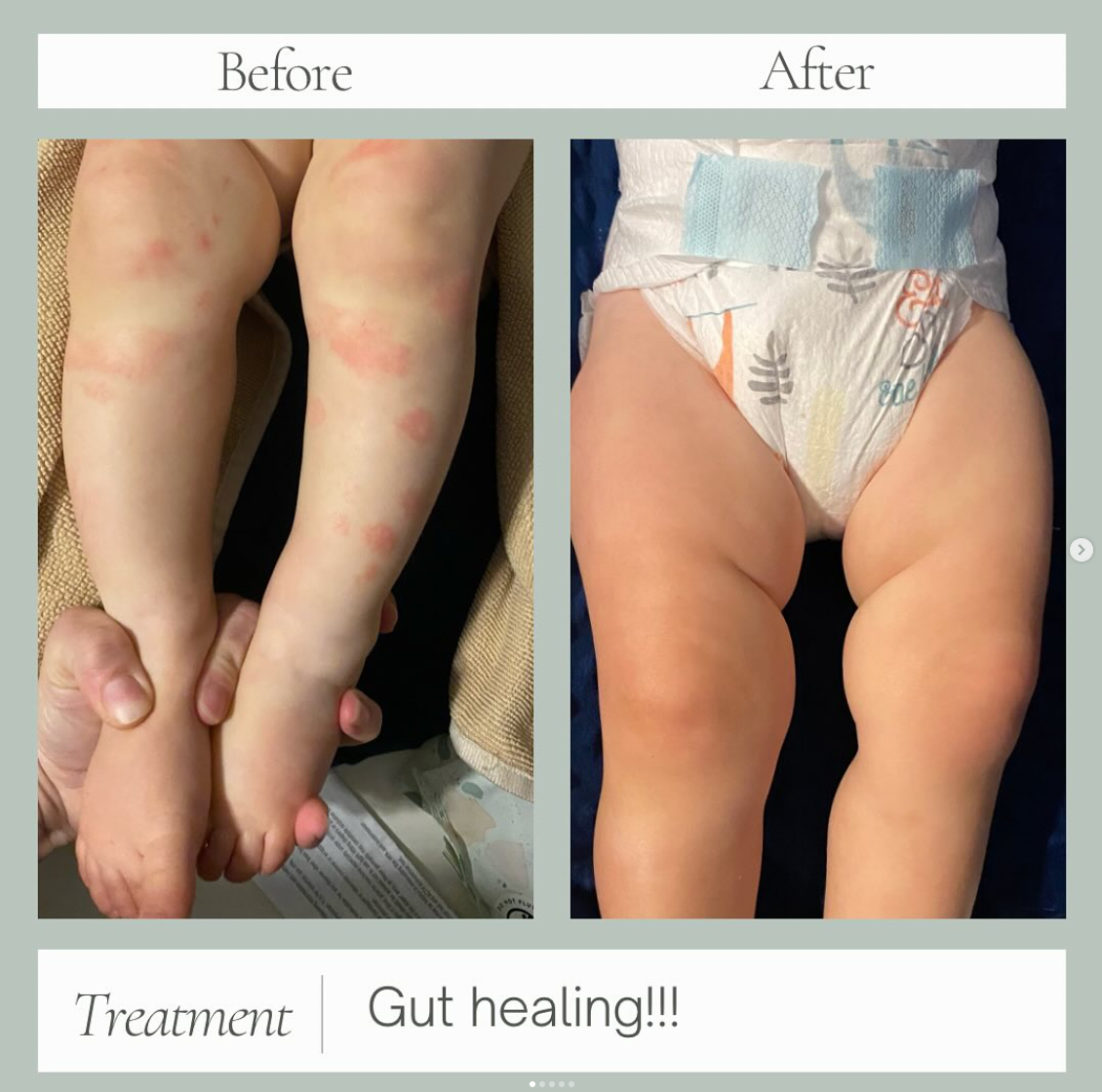 Eczema Healing 