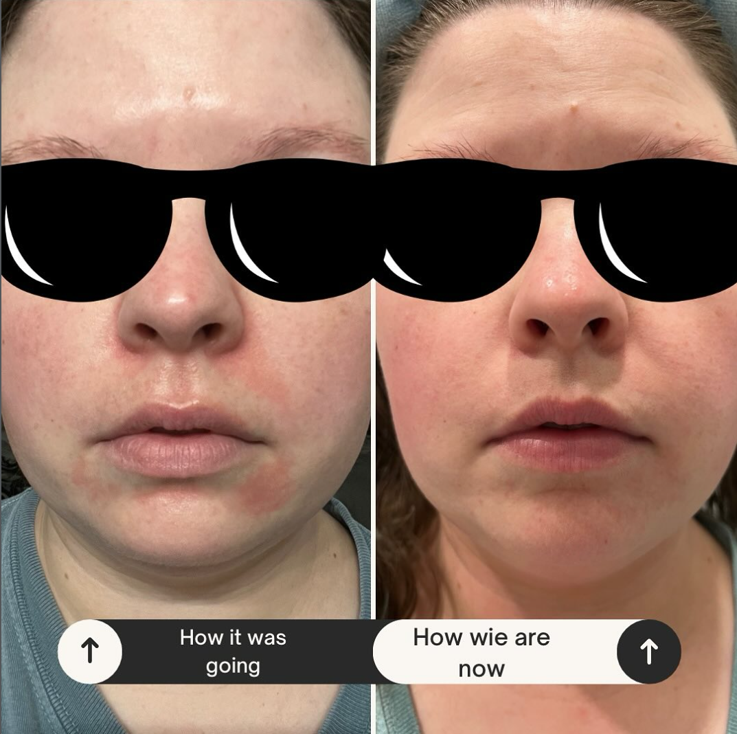 Eczema healing reduced inflammation