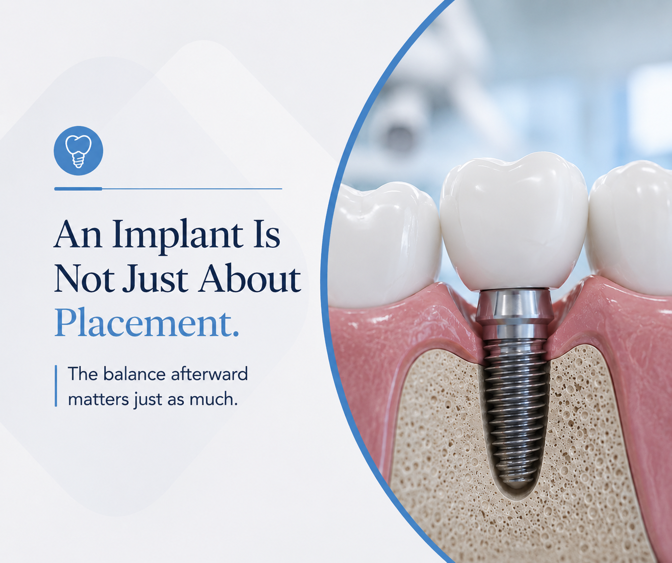 Why Chewing Still Feels Off After a Dental Implant