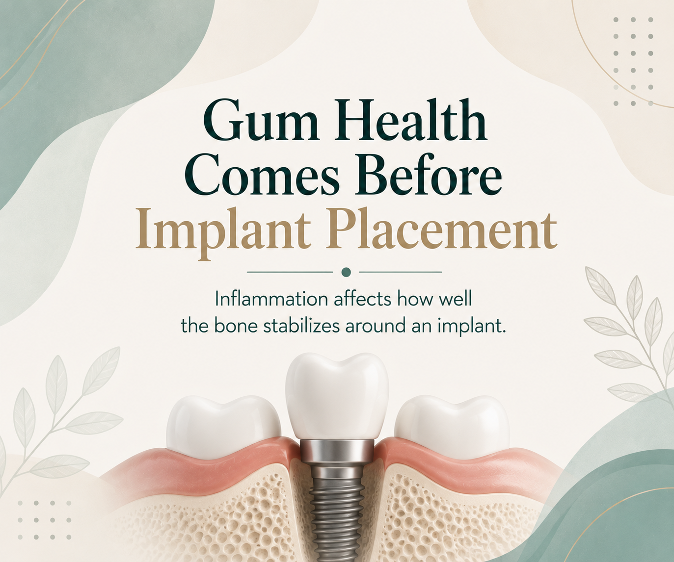 Why Gum Treatment Comes First — Before a Dental Implant