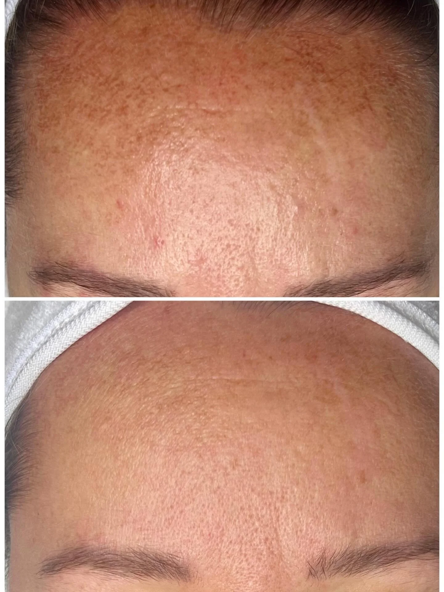 Microneedling magic ✨
Only one session and 30 days later, the texture + pigmentation are already softening.
Healthy, glowing skin is a journey &mdash; and we&rsquo;re just getting started. 💫