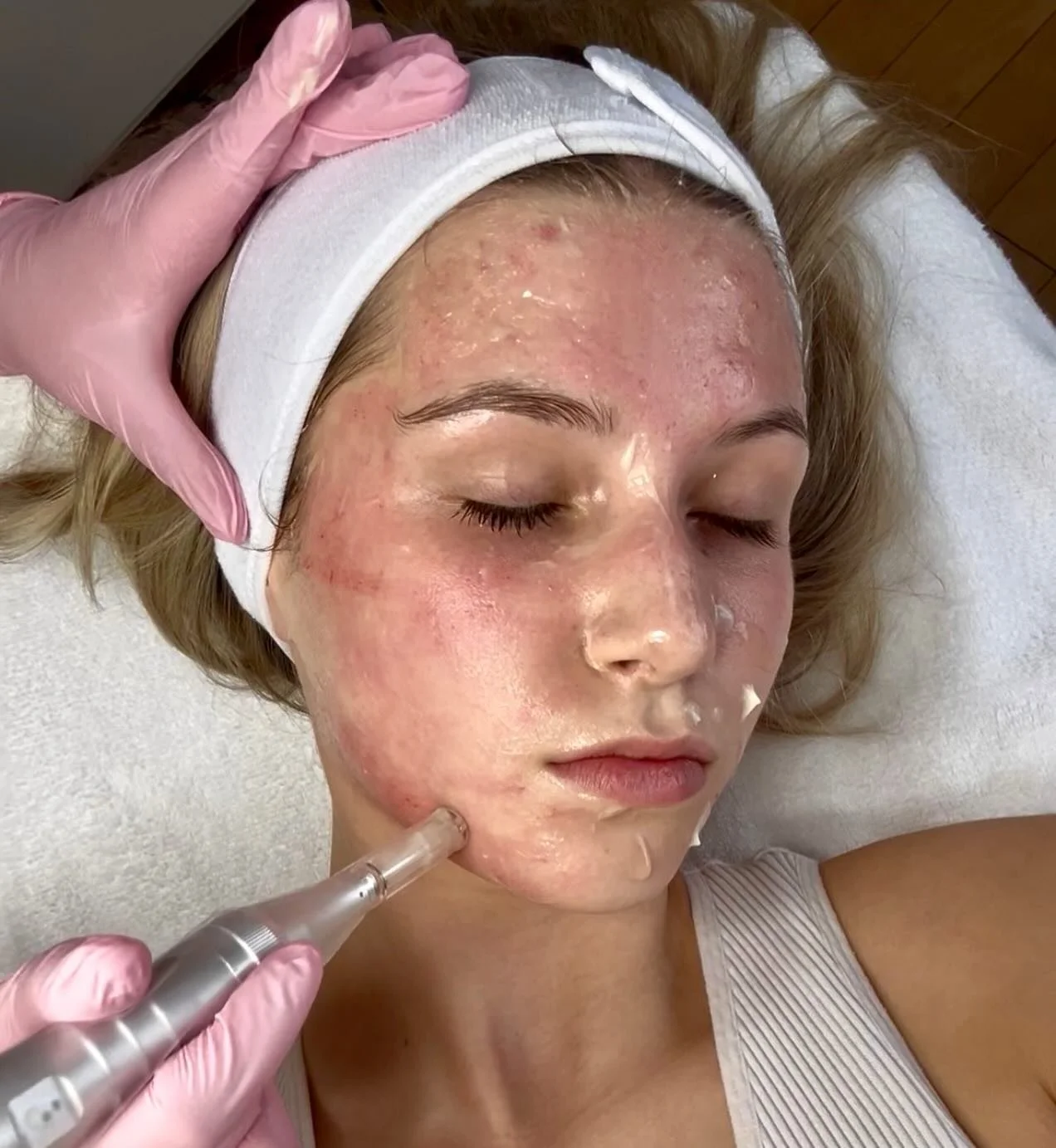 Microneedling to improve skin texture and the appearance of scars ✨
Customized treatments for your skin
Book online

Le microneedling aide &agrave; am&eacute;liorer la texture de la peau et l&rsquo;apparence des cicatrices ✨
Soins personnalis&eacute;