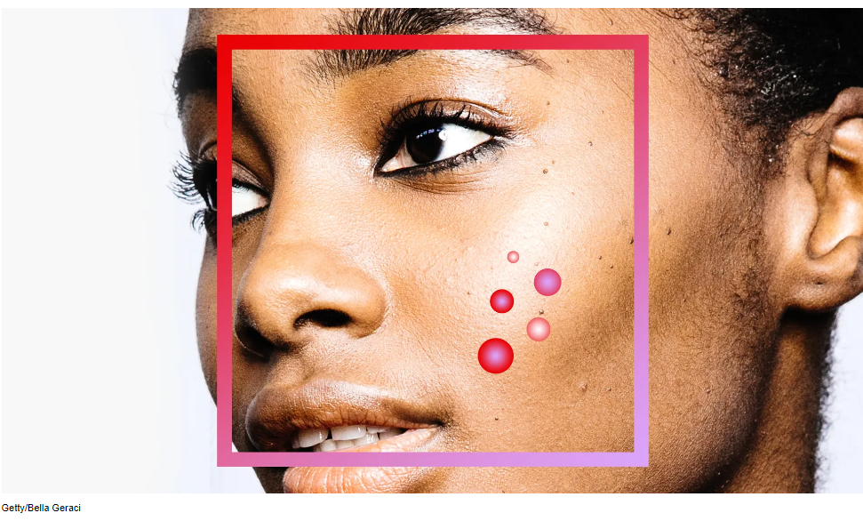 4:16-DOES STRESS CAUSE ACNE?