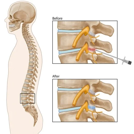 Epidurals And Spinal Injections Polio Network epidurals-and-spinal-injections-polio-network